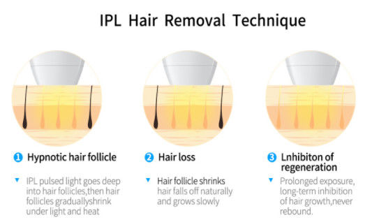 2000w OPTEER de technologie van de de DIODElaser van IPL+ 808NM voor het materiaal van de haarverwijdering